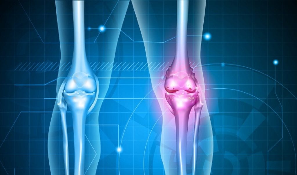 Osteoarthritis Stem Cell Therapy